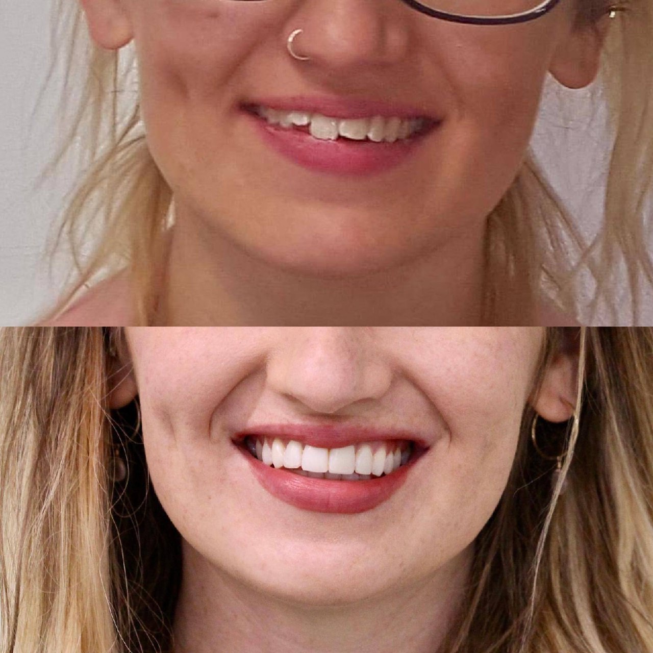 Before and after cosmetic smile transformation by Dr Jasleen