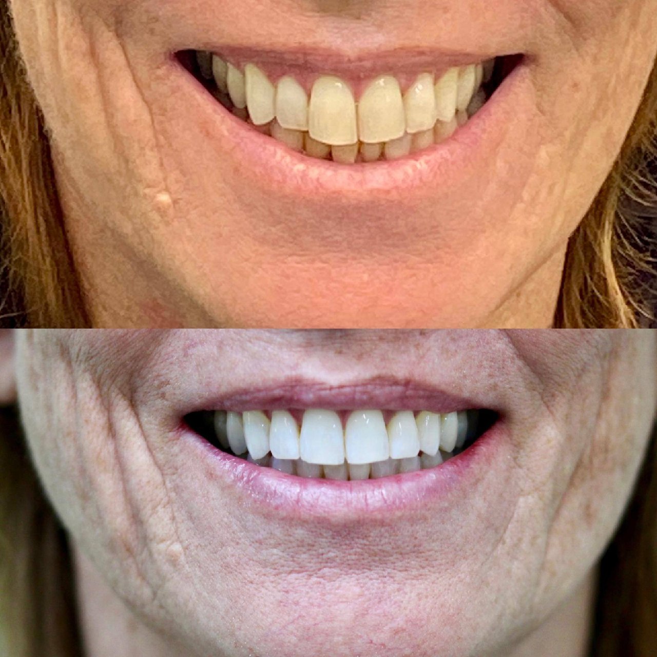 Before and after whitening and veneers by Dr Jasleen Sandhu Bournemouth