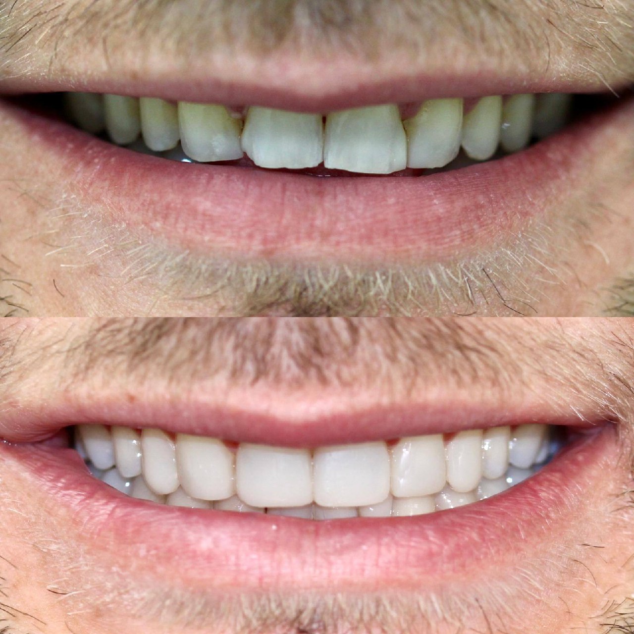 Before and after cosmetic dental work by Dr Jasleen Sandhu