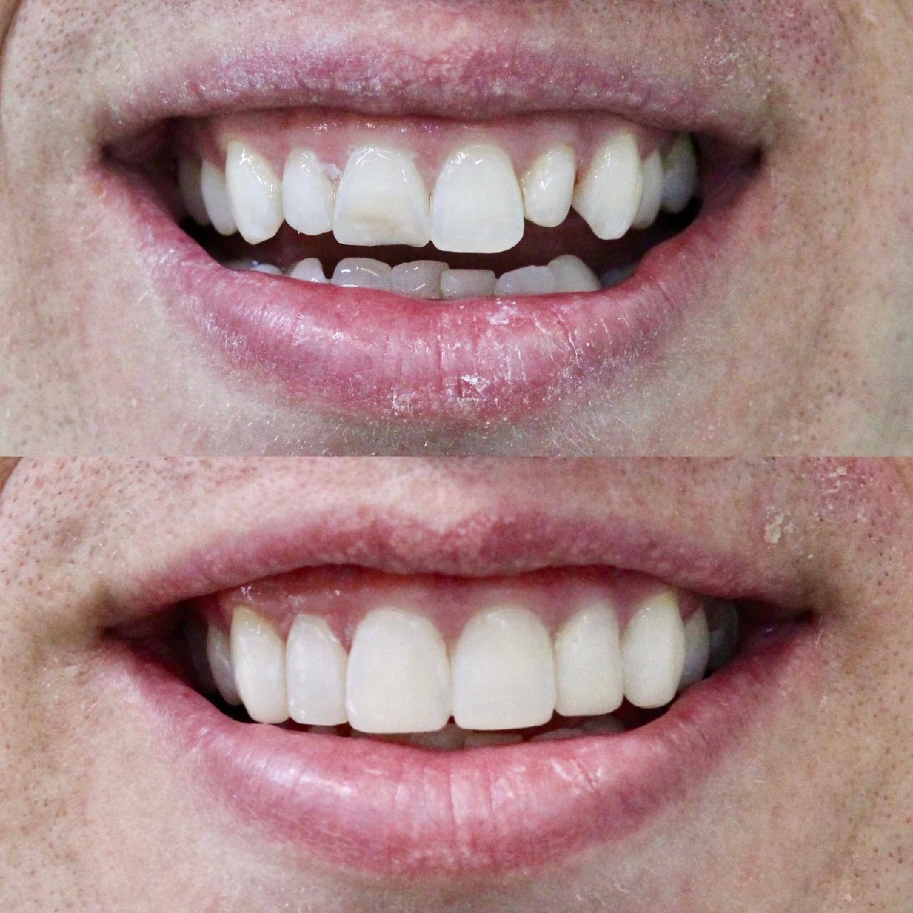 Before and after composite bonding by Dr Jasleen Sandhu