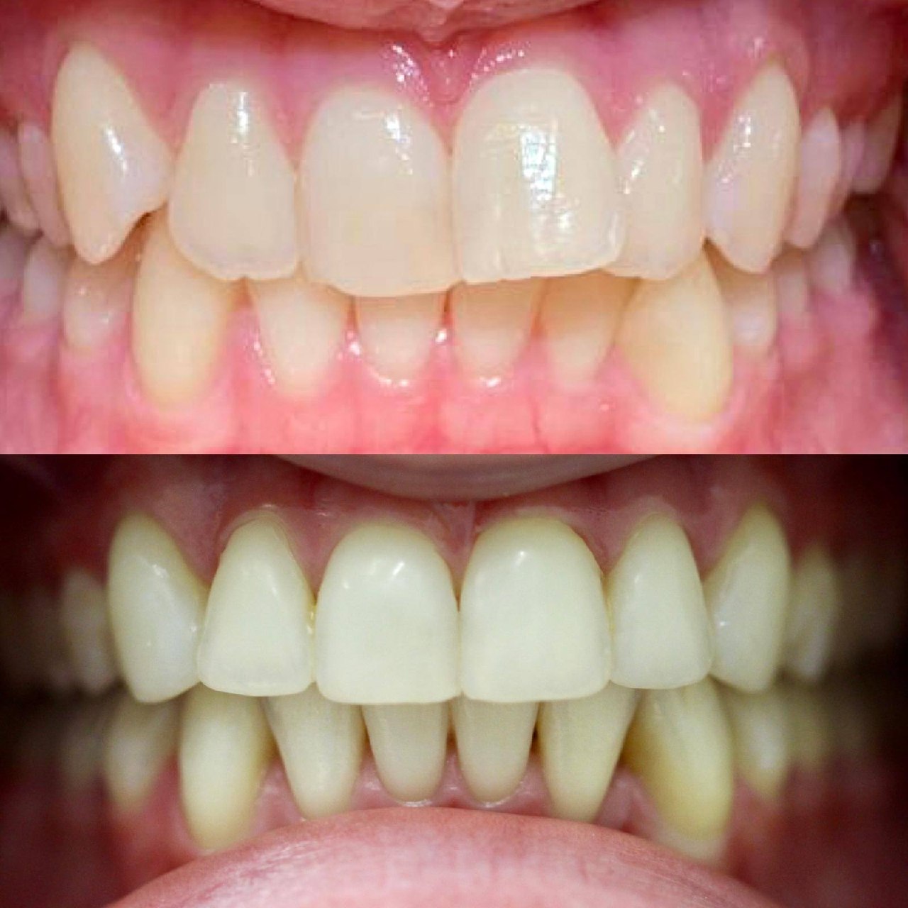 Before and after Invisalign clear aligners Bournemouth