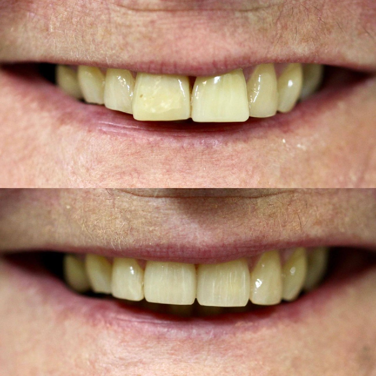 Before and after restorative dentistry Dr Jasleen Sandhu