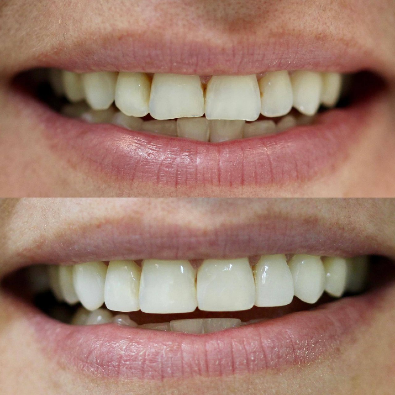Before and after teeth straightening Bournemouth dentist